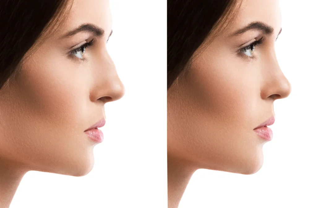 Correggere il Naso Senza Chirurgia: Rinofiller a San Giovanni Roma